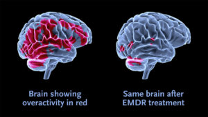 Read more about the article You Should See Me In a Crown – on EMDR Therapy- Part 1.